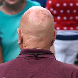 الصلع مشكلة تؤرق الرجال والنساء على السواء