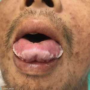 الطبقة البيضاء سببت ألما في فم المريض