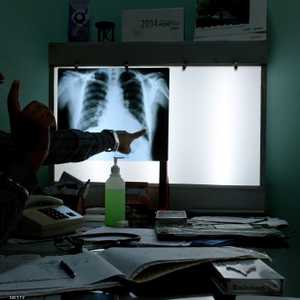 مرض غامض بالجهاز التنفسي مرتبط بالتدخين الإلكتروني