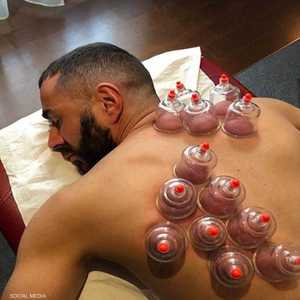 بنزيمة وهو يتعالج بالحجامة