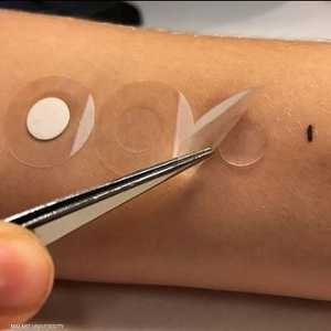 أداة جديدة للتعرف على صلة الشامة بالسرطان