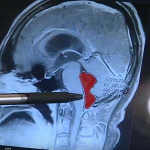 صورة الأشعة أثبتت وجود دودة في المخ