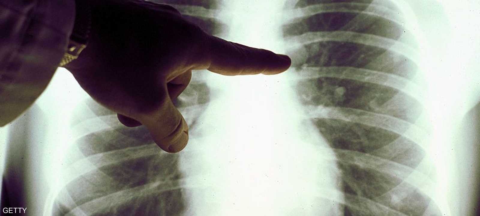 حرب الطب مستمرة للقضاء على السرطان