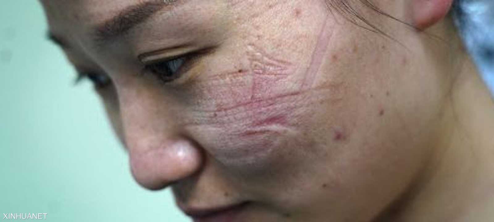 ارتداء الكمامات لأوقات طويلة يضر ببشرة الوجه