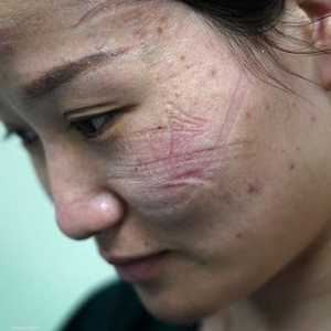 ارتداء الكمامات لأوقات طويلة يضر ببشرة الوجه