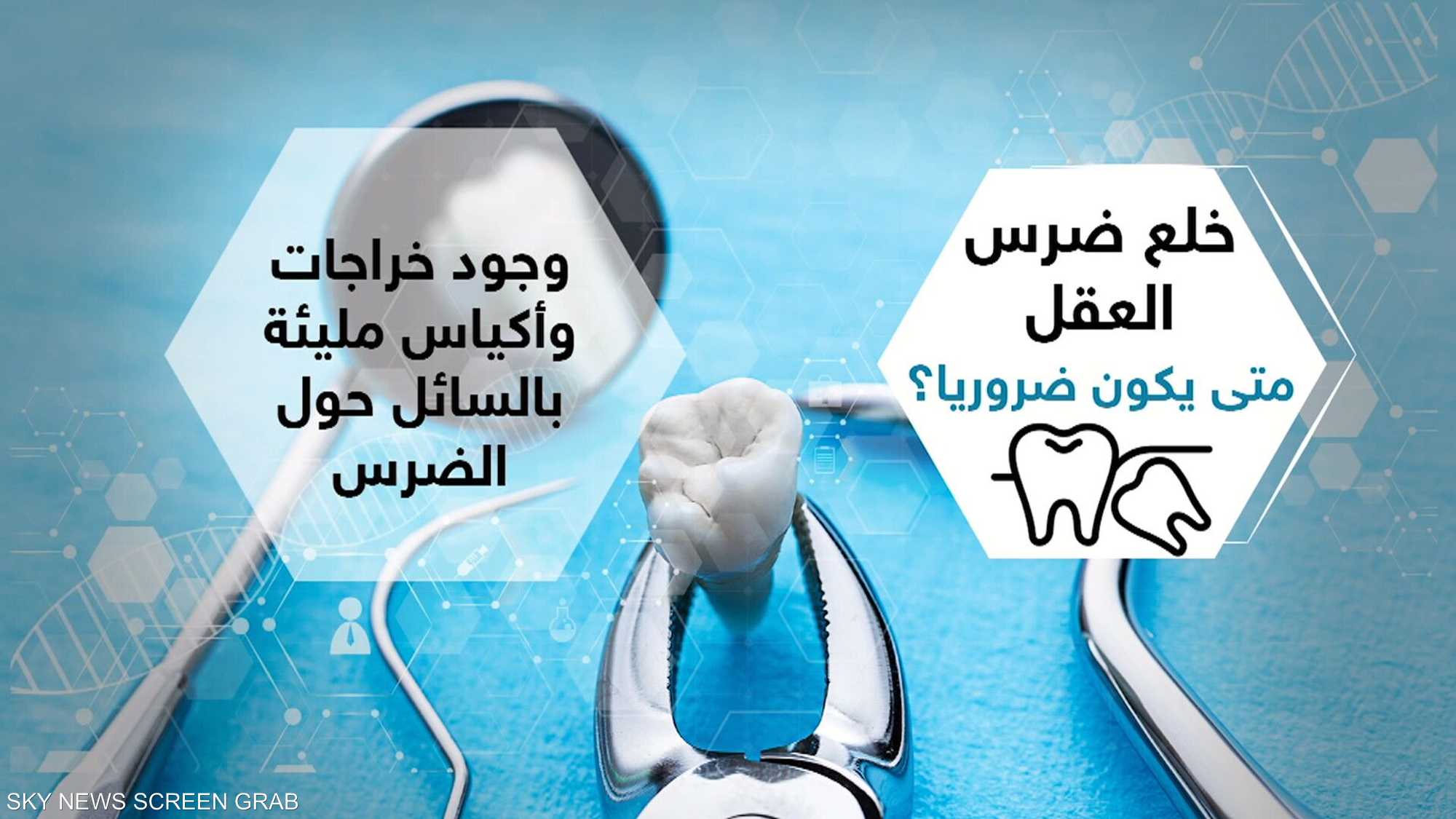 قلع ضرس العقل قد يتطلب جراحة في بعض الحالات