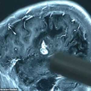 الأشعة المقطعية أظهرت وجود الدودة الشريطية في دماغ الشاب.