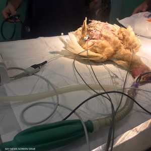 خلال العملية الجراحية