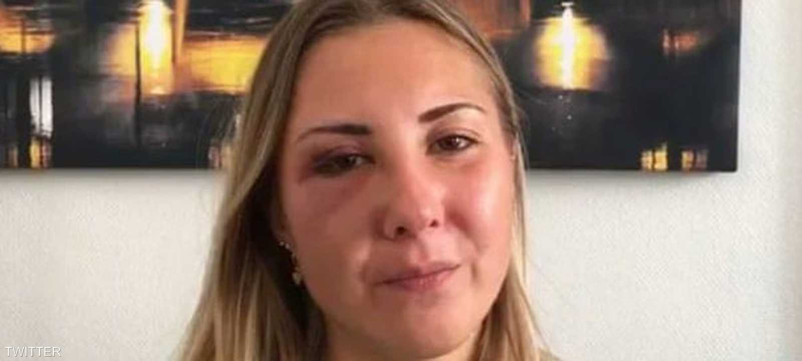 إليزابيث والكدمات تغطي وجهها