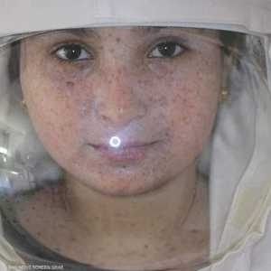 أطفال القمر عليهم حماية أنفسهم من الأضواء