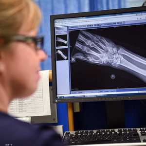 يعد هشاشة العظام، واحدا من أكثر الأمراض انتشارا حول العالم