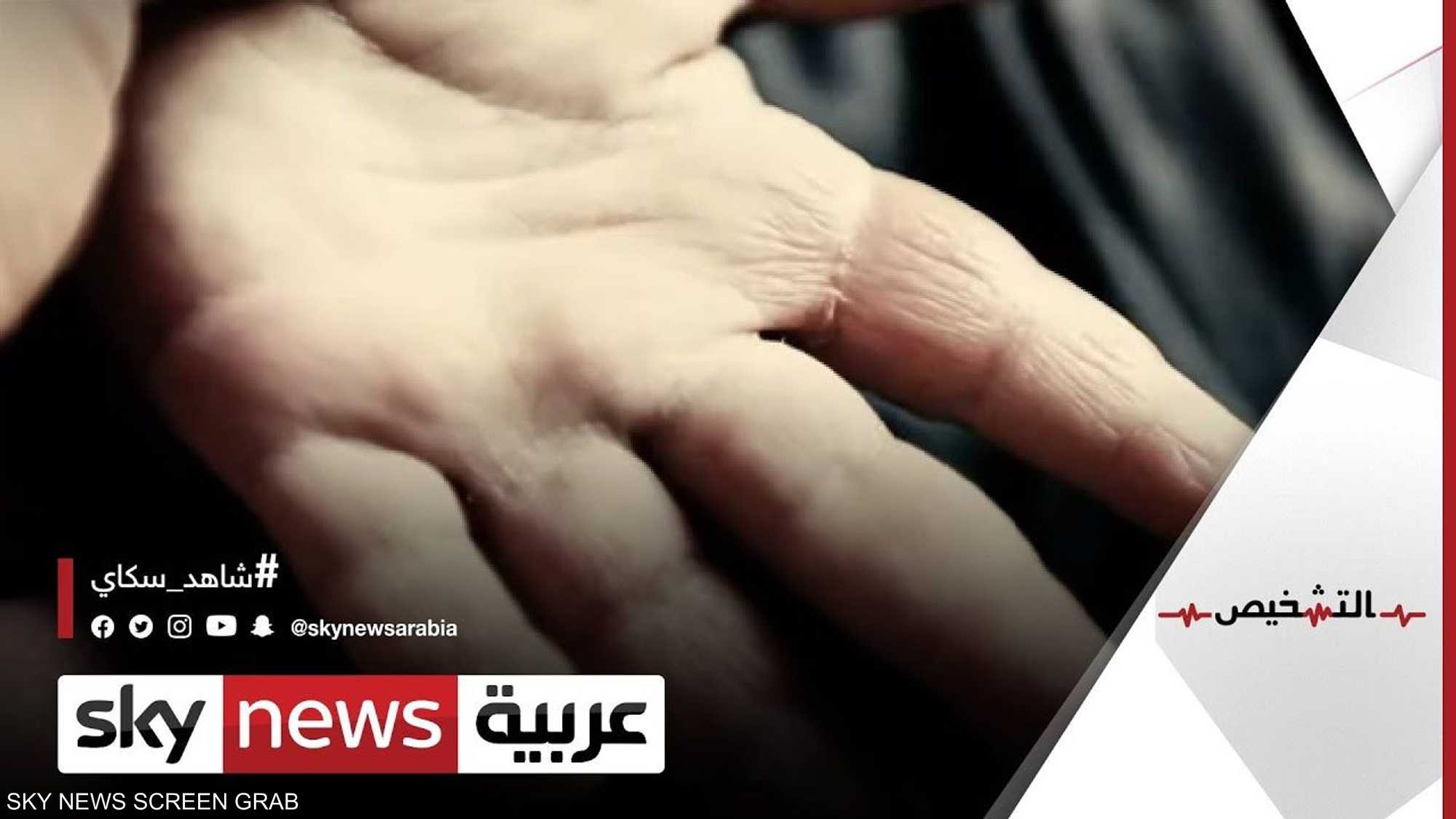 الإكزيما.. الأسباب والعلاج