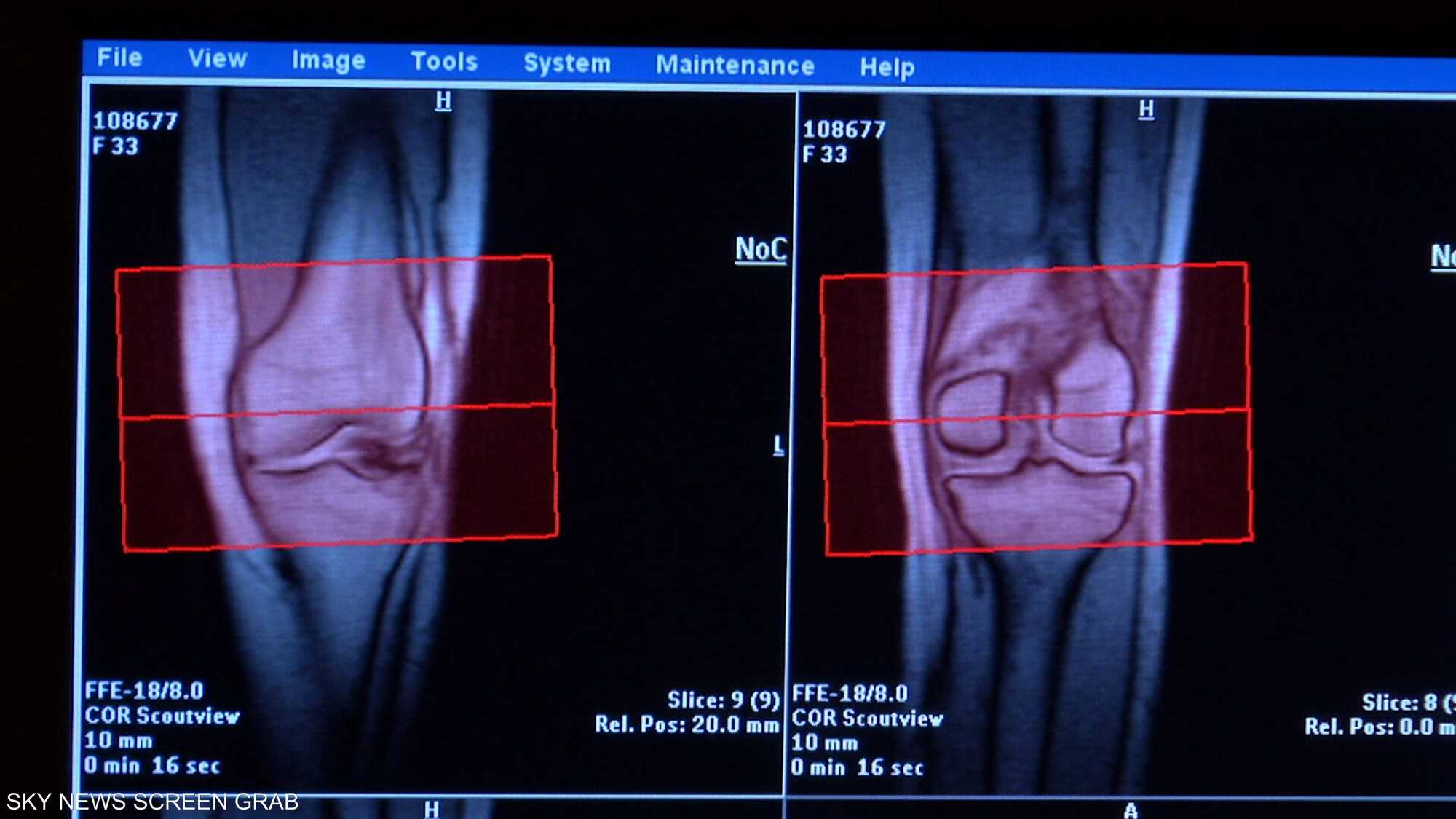 إصابات الركبة تتنوع بين الخفيفة والمتوسطة والحادة
