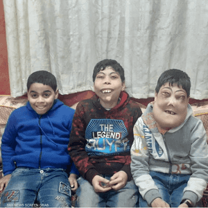 "اخلع الماسك".. معاناة طفلين مصريين مع المرض النادر