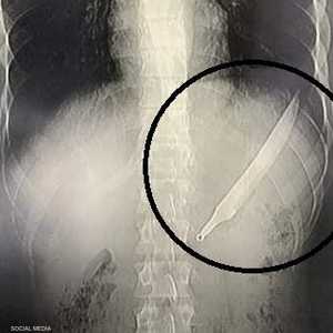 السكين مستقر في بطن الرجل قبل إخراجه