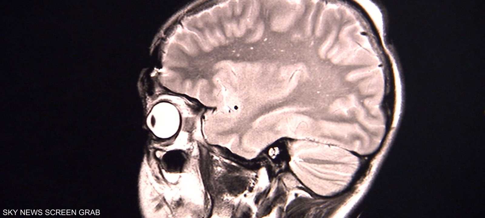يعتقد العلماء أن كورونا يتسبب في التهاب بالدماغ.