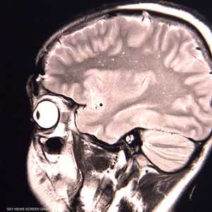 يعتقد العلماء أن كورونا يتسبب في التهاب بالدماغ.