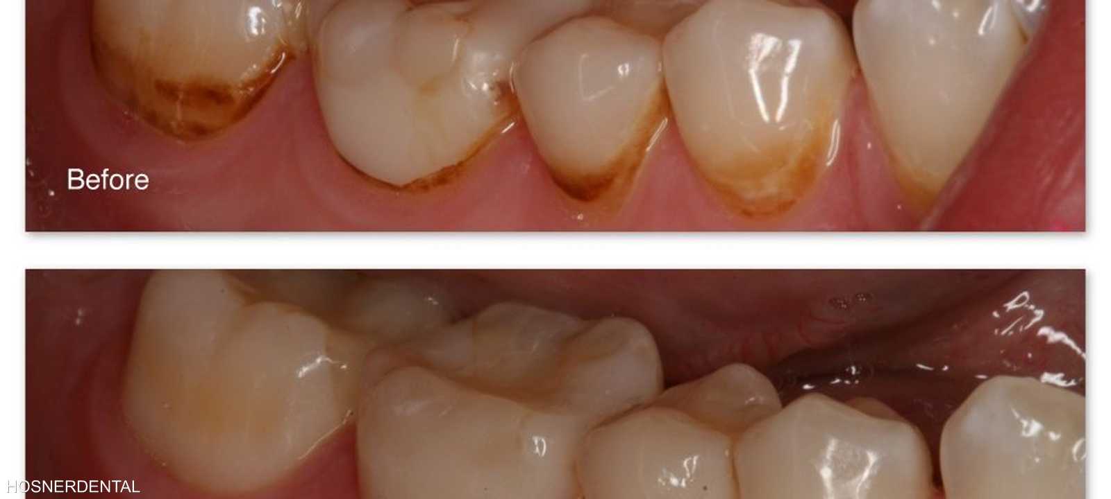 مثال عن البقع البنية على الأسنان