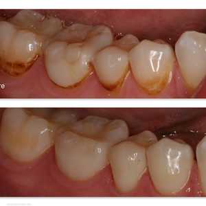 مثال عن البقع البنية على الأسنان