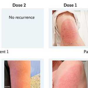 طفح جلدي على الذراع بعد أخذ لقاح كورونا
