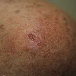 اللقاح مصصم بشكل شخصي لكل مريض على حدة.