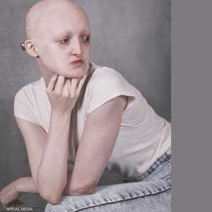 تعاني هانا هاربين منذ ولادتها من متلازمة "هي ويلس"