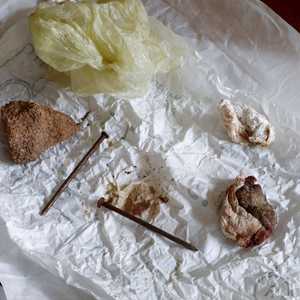 أطباء استأصلوا مواد معدنية من امرأة تعرضت للاغتصاب في تيغراي