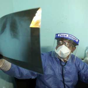 تسجيل أعراض جديدة لكورونا في مصر