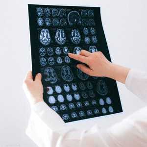 10 بالمئة من مرضى كورونا يعانون من مشكلات في الدماغ