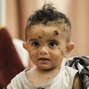 طفل فلسطيني أصيب خلال القصف الإسرائيلي على غزة.