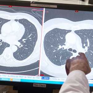 صورة أرشيفية لخلايا سرطانية