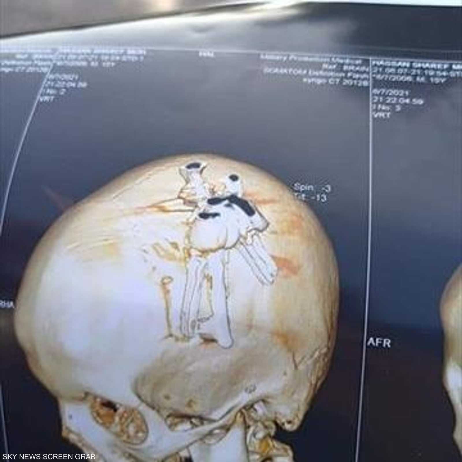 كسر في الجمجمة