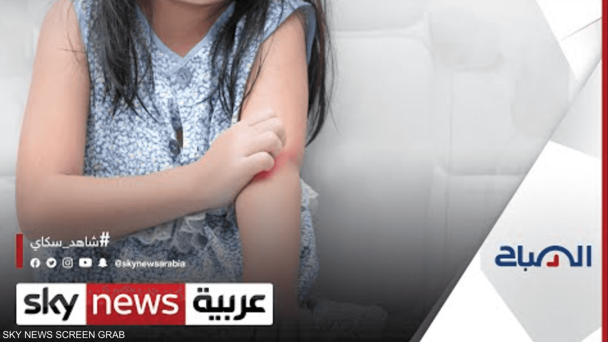 حساسية الجلد عند الأطفال.. متى تستدعي استشارة الطبيب؟