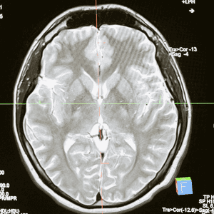 لأول مرة.. دراسة تكشف "معادن" داخل دماغ الإنسان