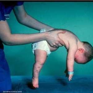 مرض ضمور العضلات يصيب الأطفال حديثي الولادة