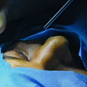 أرشيفية لمريضة تعاني الإصابة بالفطر الأسود