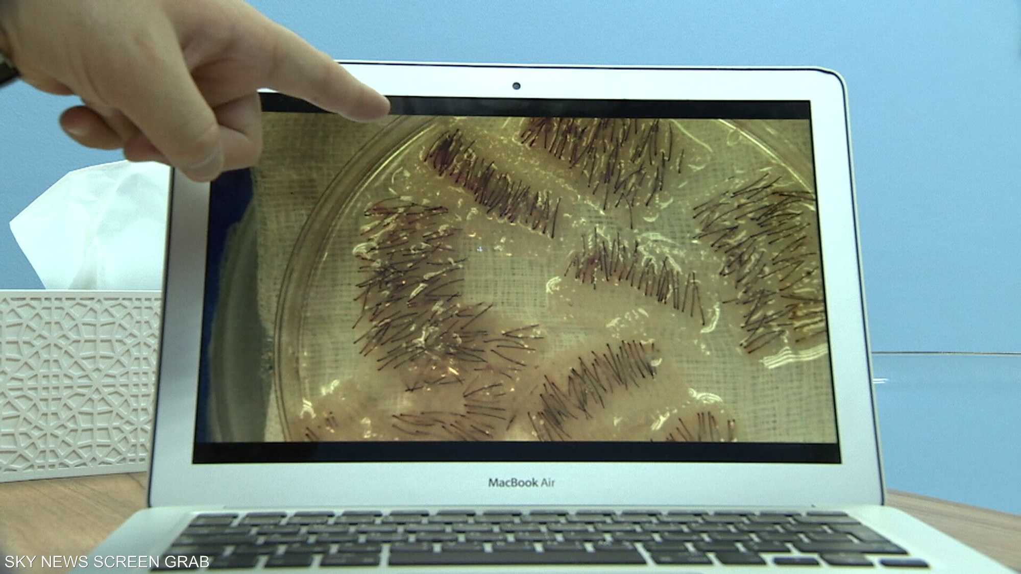 قشرة الرأس مشكلة جلدية ترتبط بفروة الرأس الدهنية