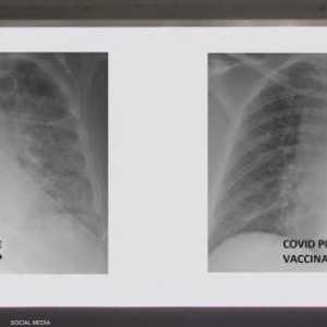 الصور الأولى (يمين) لرئتي شخص ملقح والثانية لشخص غير ملقح