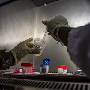 أرشيفية.. تحليل طبي للكشف عن حصوات الكلى