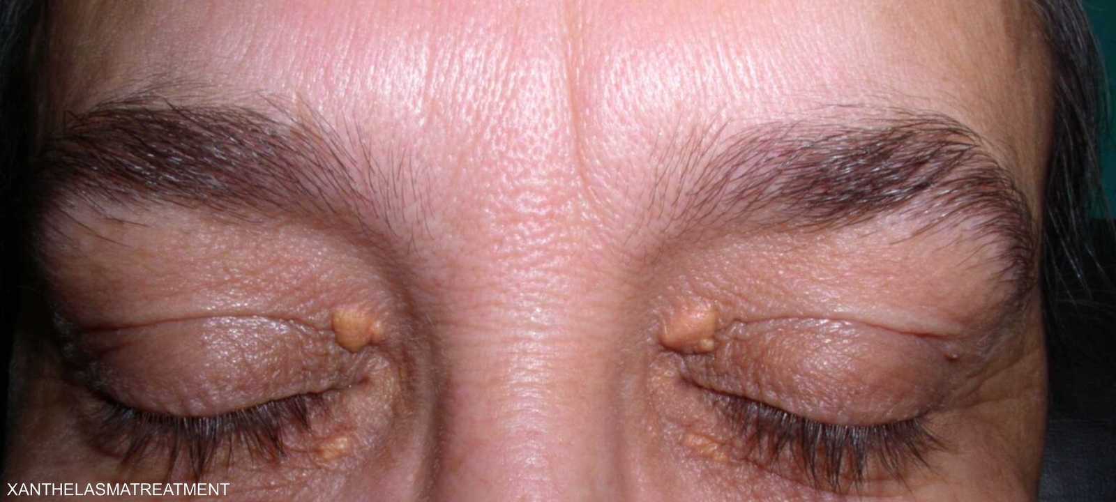 الفقاعات تظهر في عدة مناطق من الجسم