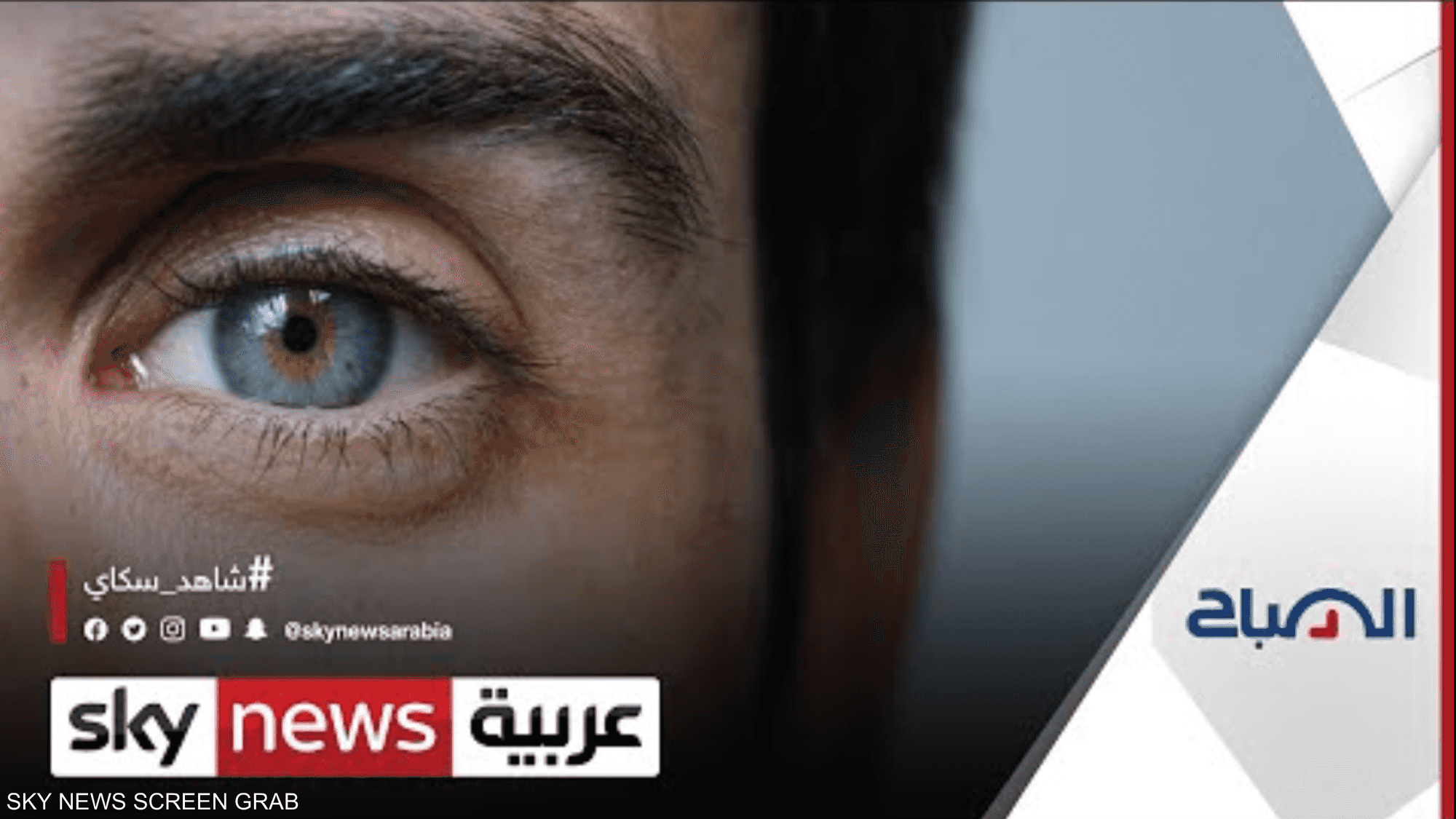 ما خطورة المياه البيضاء في العين؟