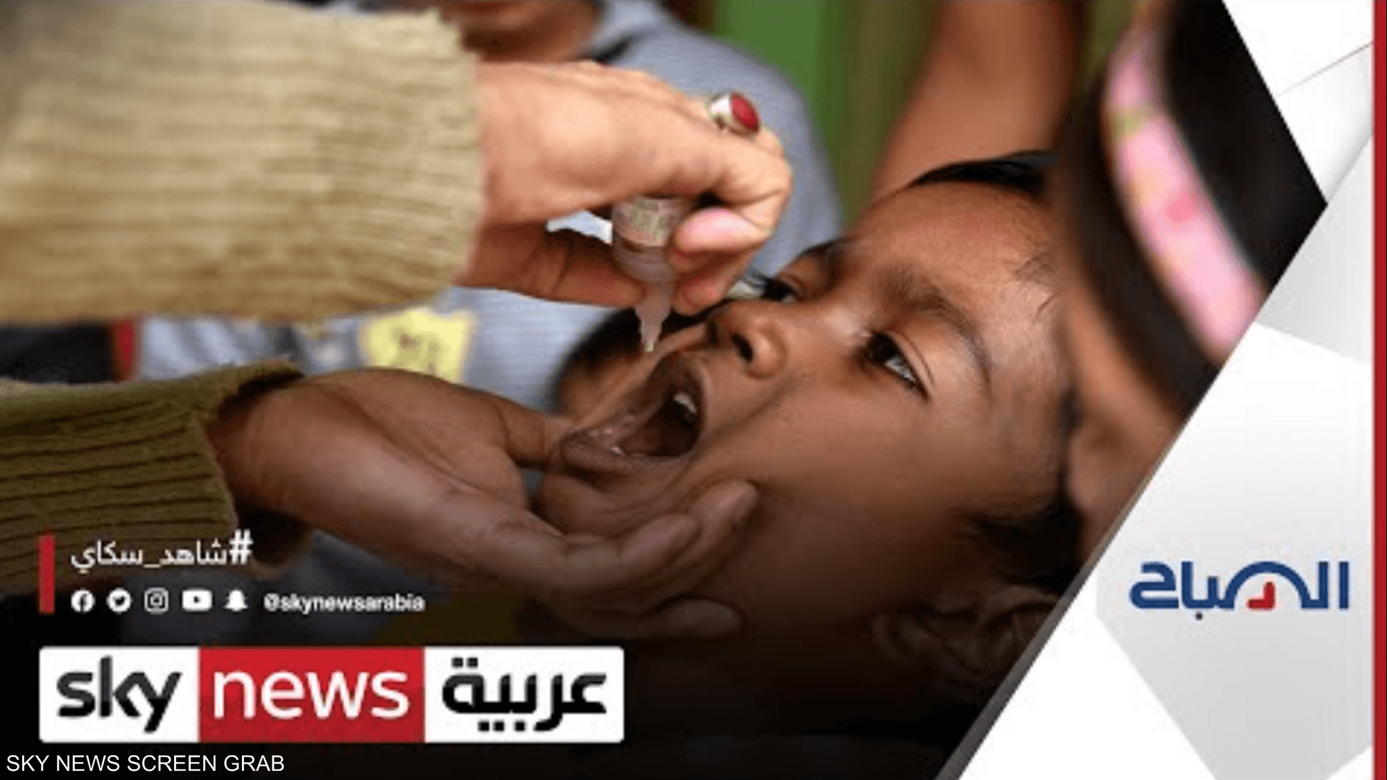 في اليوم العالمي لشلل الأطفال.. دعوات لتشجيع حملات التطعيم
