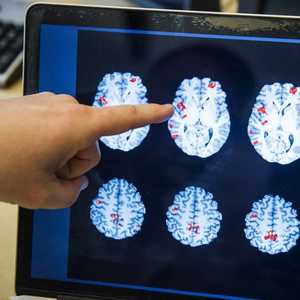 أرشيفية.. تشمل أعراض الزهايمر فقدان الذاكرة ومهارات التفكير