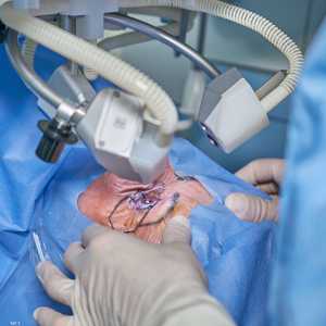 أطباء: "جراحة الساد" تخفض خطر الإصابة بالخرف