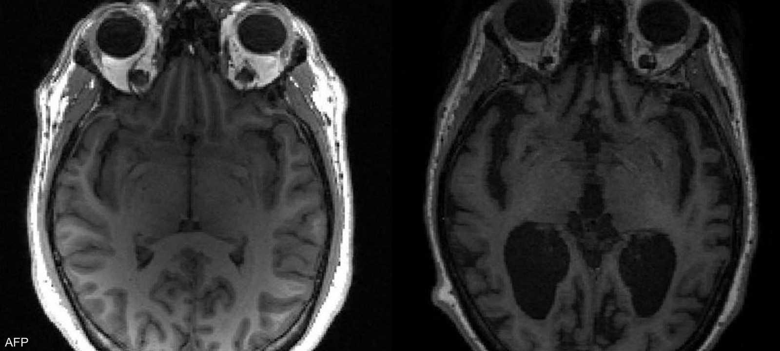 دماغ سليم "يسار" مقارنة بدماغ مصاب بألزهايمر (يمين)