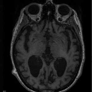 دماغ سليم "يسار" مقارنة بدماغ مصاب بألزهايمر (يمين)