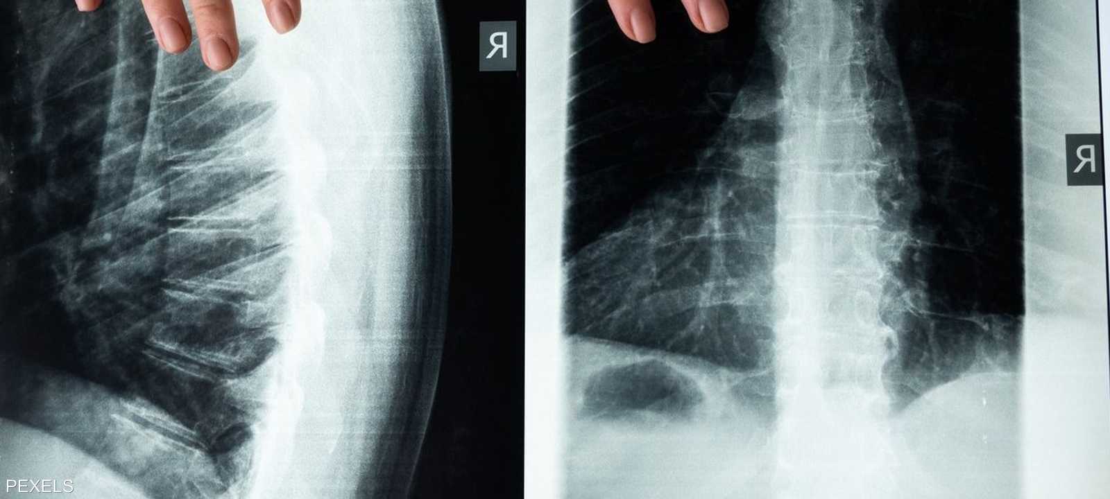 العلاج الجديد قد يشفي بعض حالات الشلل