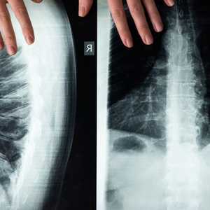 العلاج الجديد قد يشفي بعض حالات الشلل