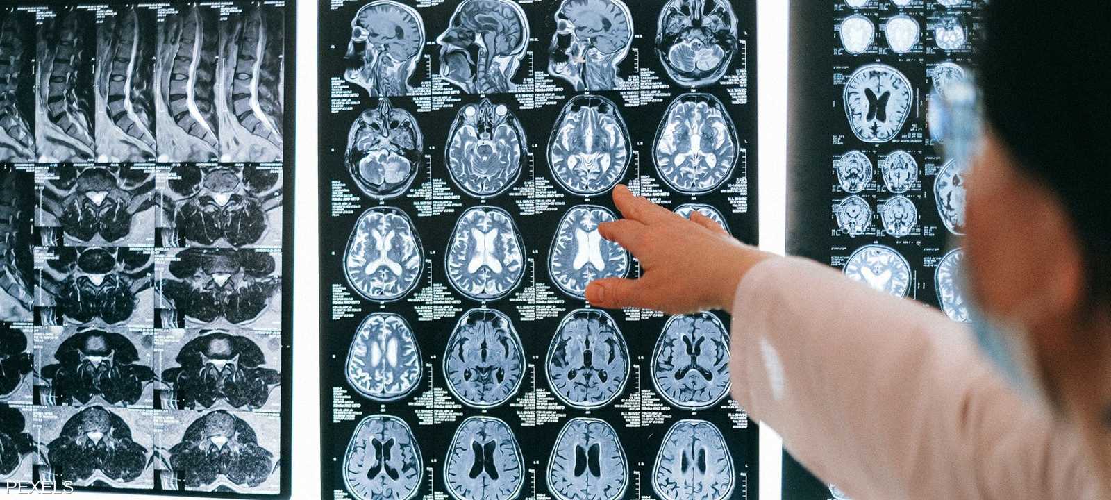 بعض الأشخاص الذين أصيبوا بكوفيد-19يعانون من ضبابية في الدماغ