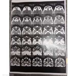 الأشعة لم تكشف عن ماهية الجسم قرب عين الطفل